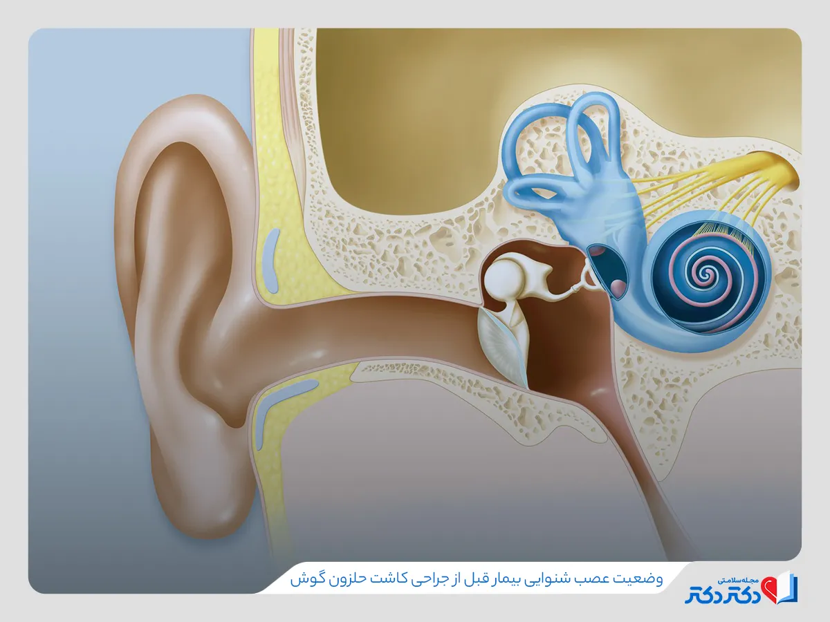 وضعیت عصب شنوایی قبل از جراحی کاشت حلزون گوش