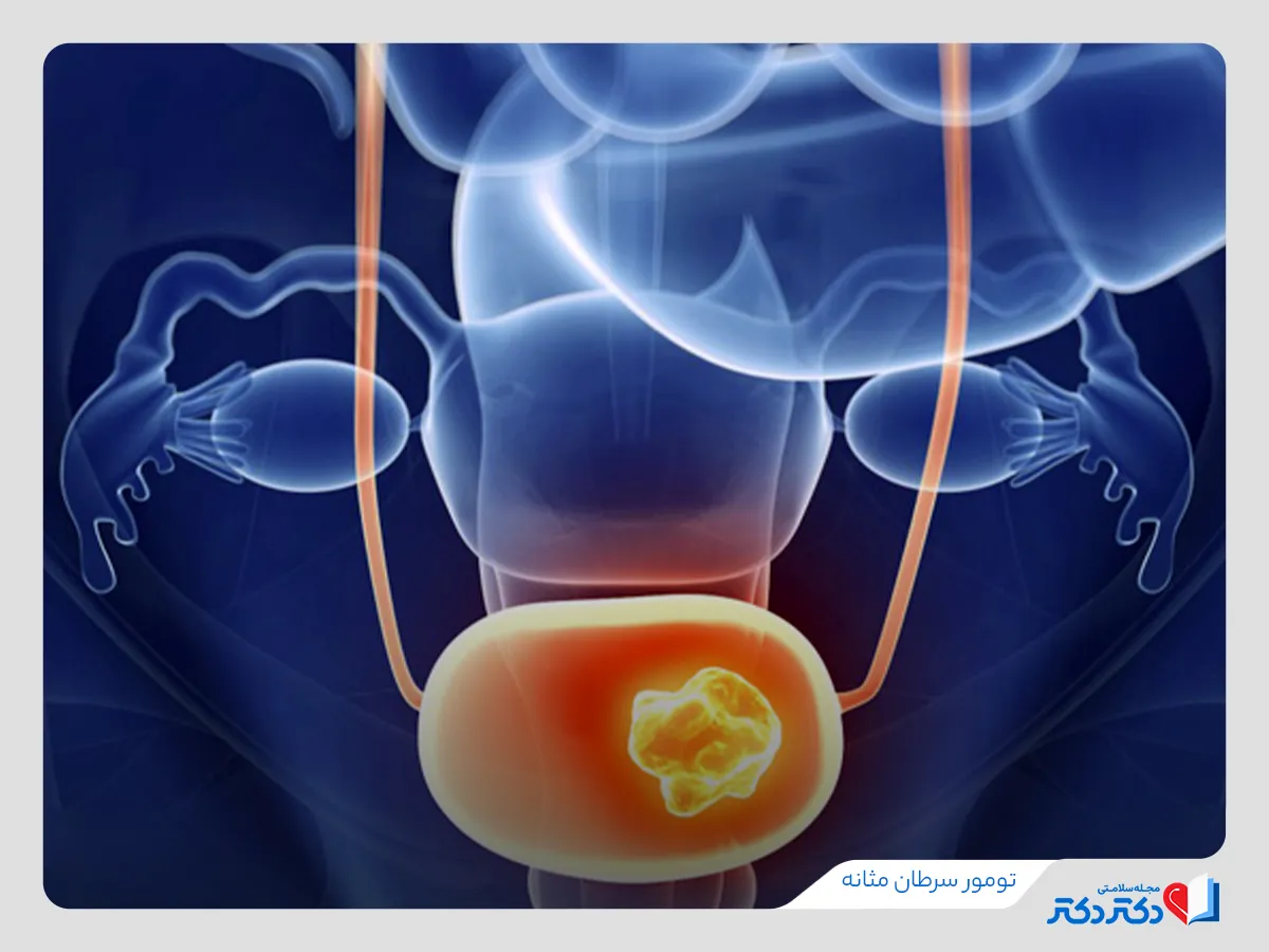 تومور در لیست موارد تشخیص سرطان مثانه است.