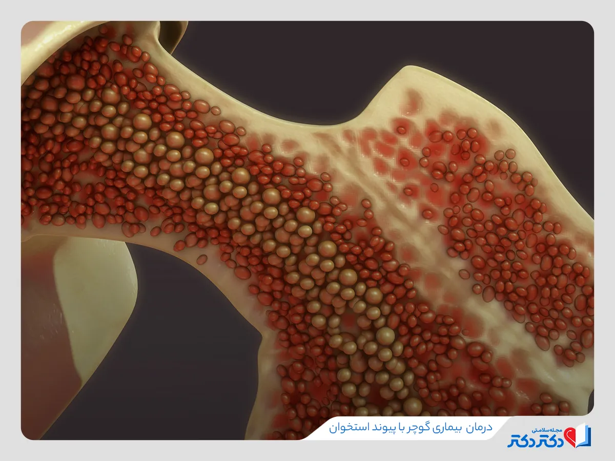 پیوند مغز استخوان برای درمان بیماری گوچر 