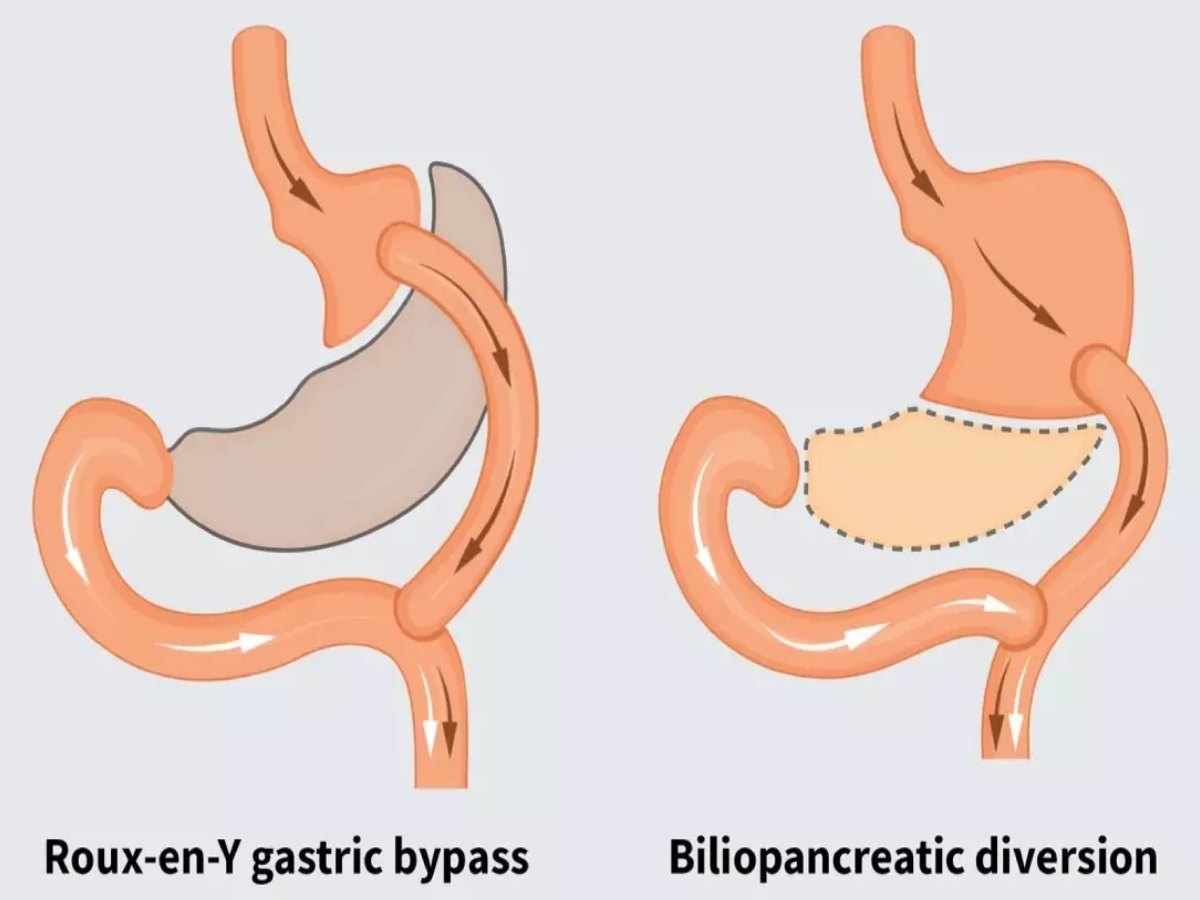 جراحی بای پس معده