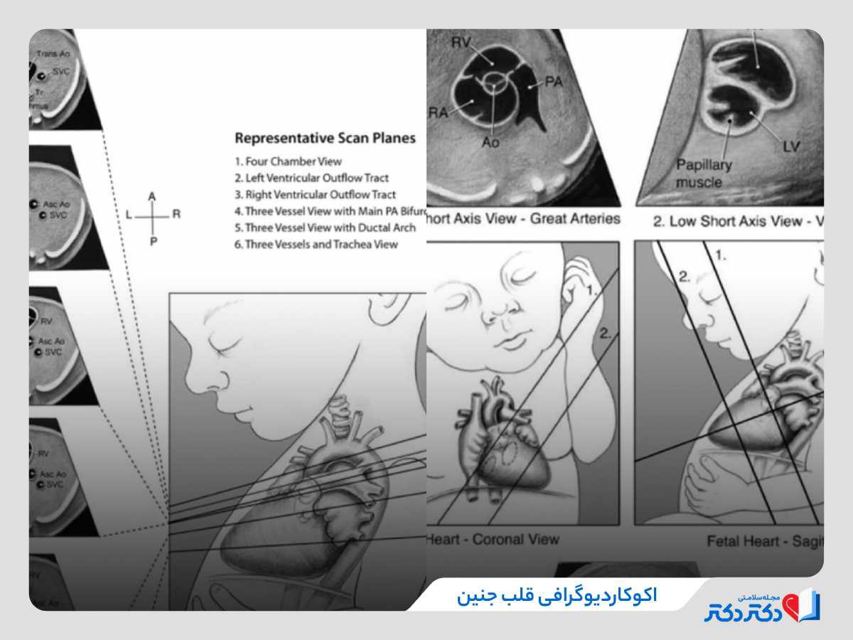 اکوکاردیوگرافی براساس ISUOG