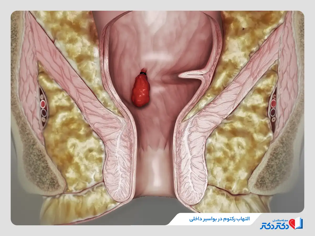 درمان بواسیر داخلی با روش‌های جراحی یا خانگی