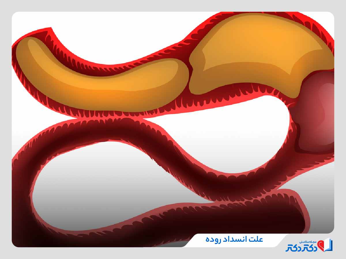 علت انسداد روده چرا اتفاق می‌افتد؟ + علت و درمان انسداد روده