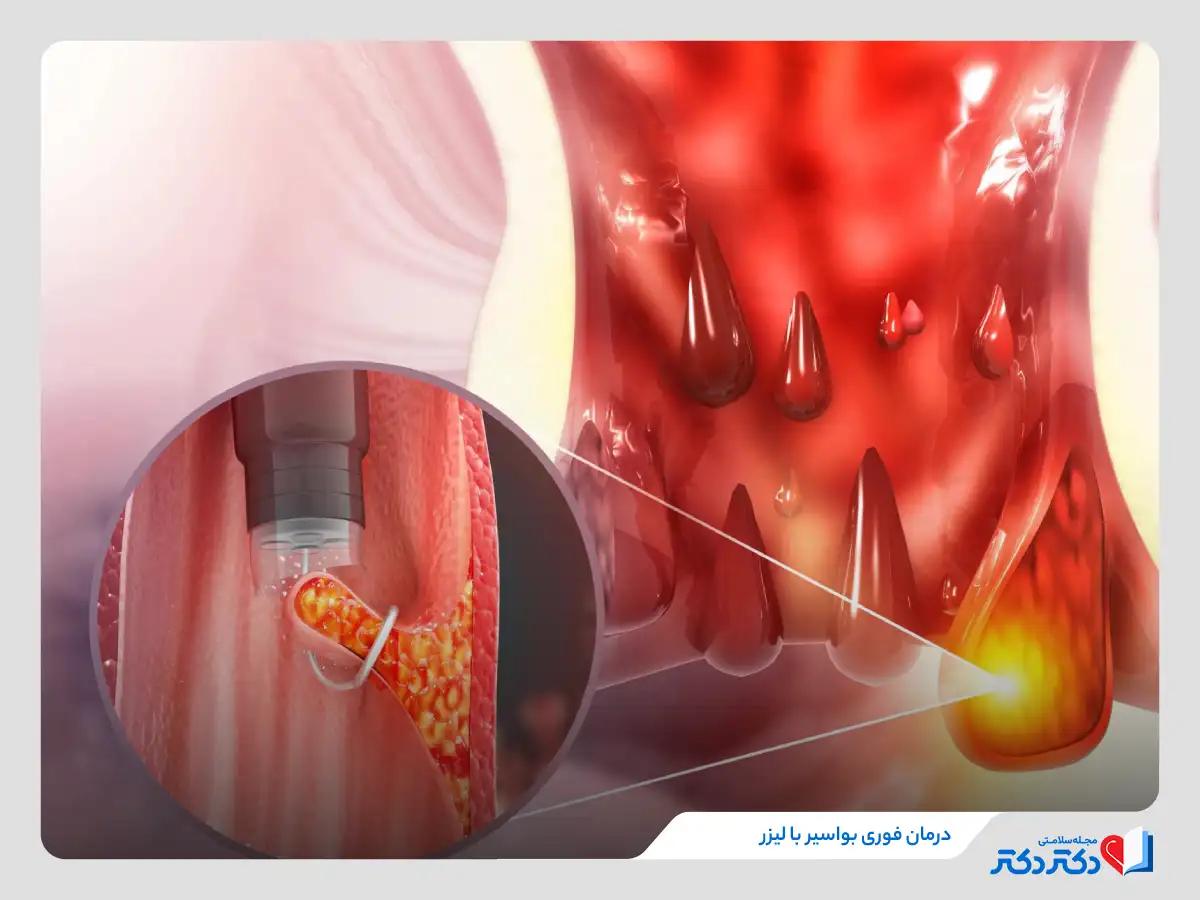 استفاده از لیزردرمانی برای درمان فوری بواسیر