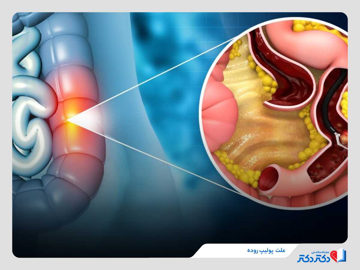 علت پولیپ روده و ایجاد برجستگی‌ها در دیواره روده