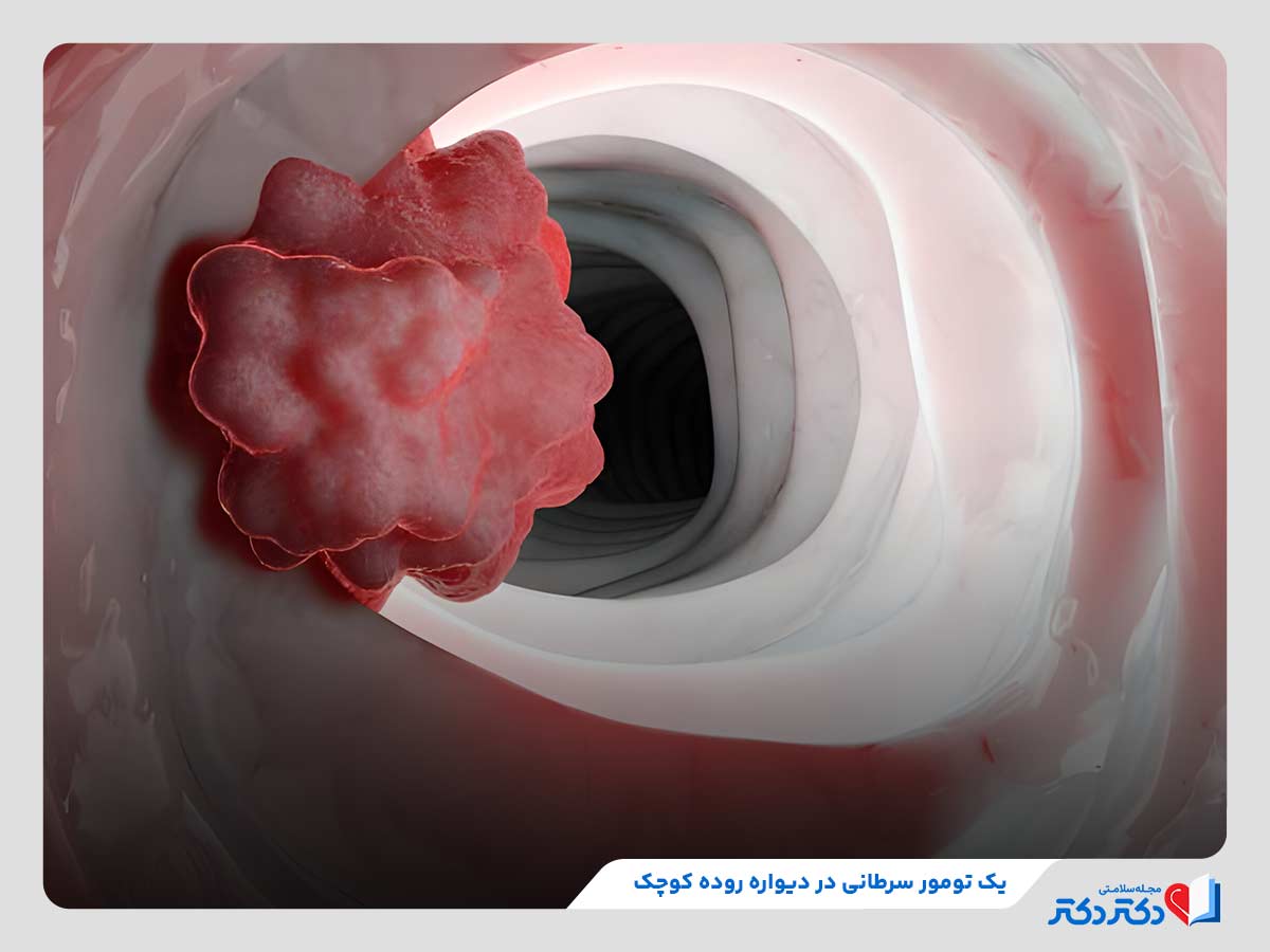 تکثیر غیرعادی سلول‌ها عامل اصلی ابتلا به سرطان روده کوچک