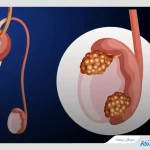 سرطان بیضه چیست + تشخیص، علائم و درمان سرطان بیضه