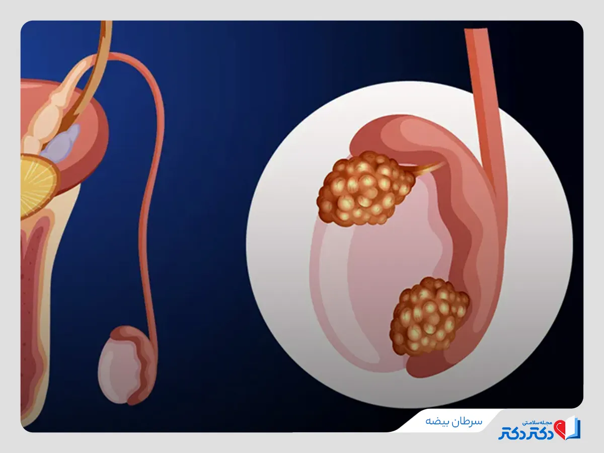 سرطان بیضه چیست؟