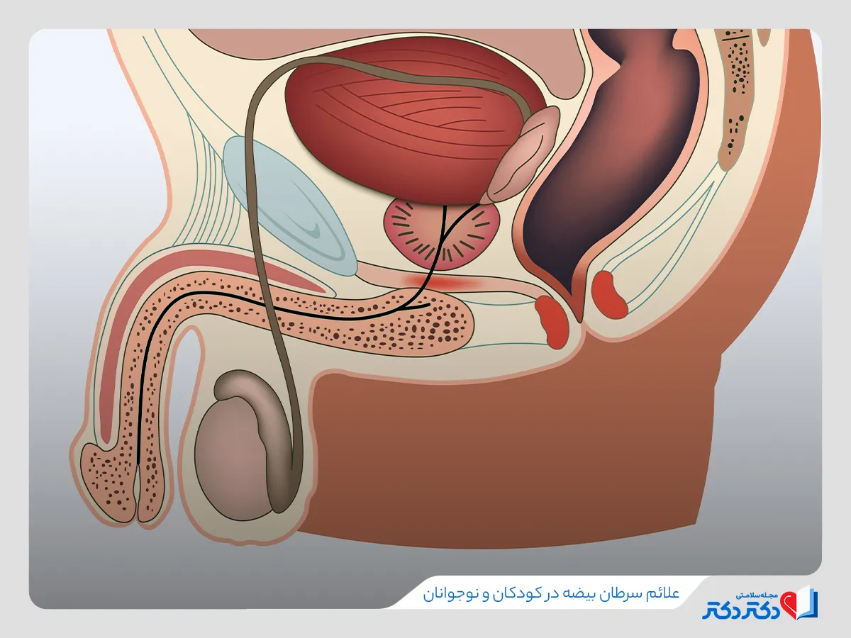 تصویر شماتیک علائم سرطان بیضه برای کودکان