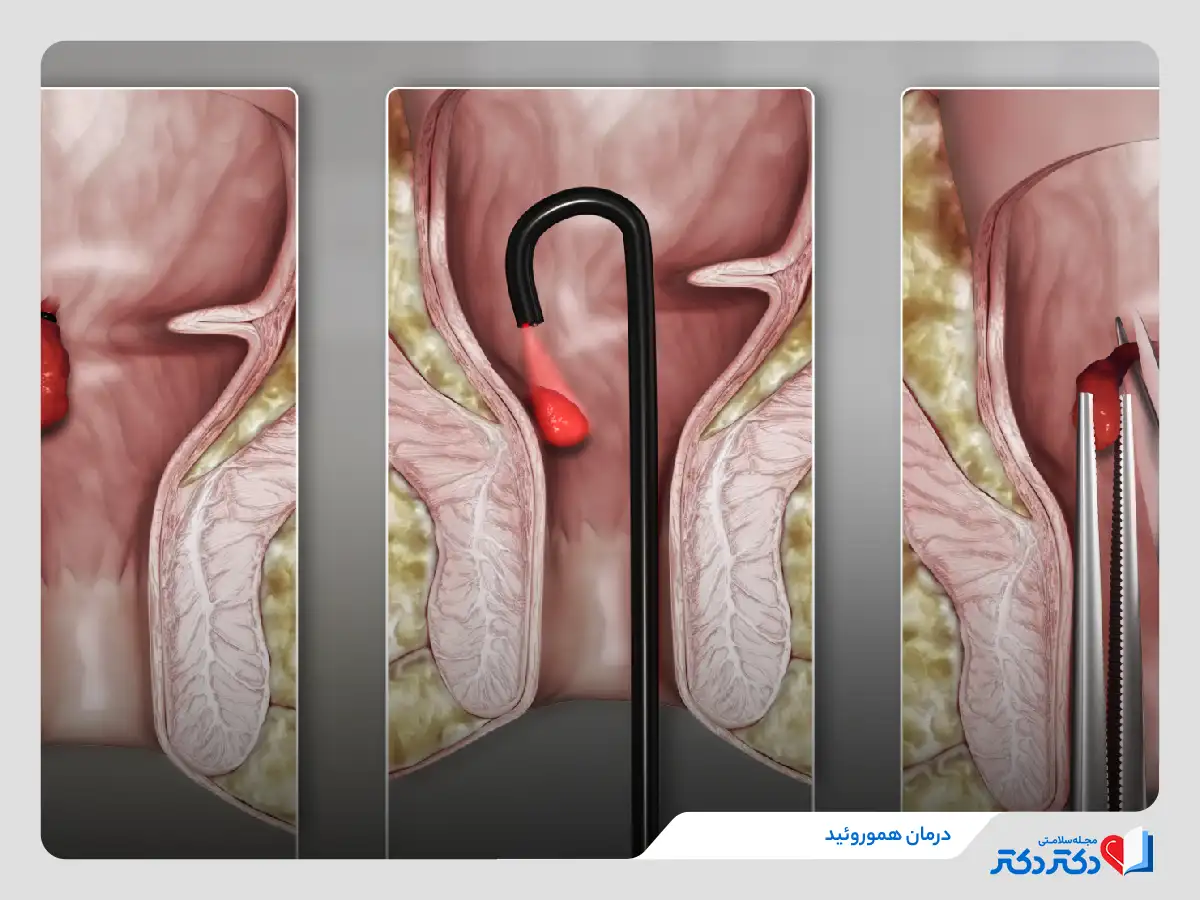 درمان هموروئید با روش‌های مداخله پزشکی