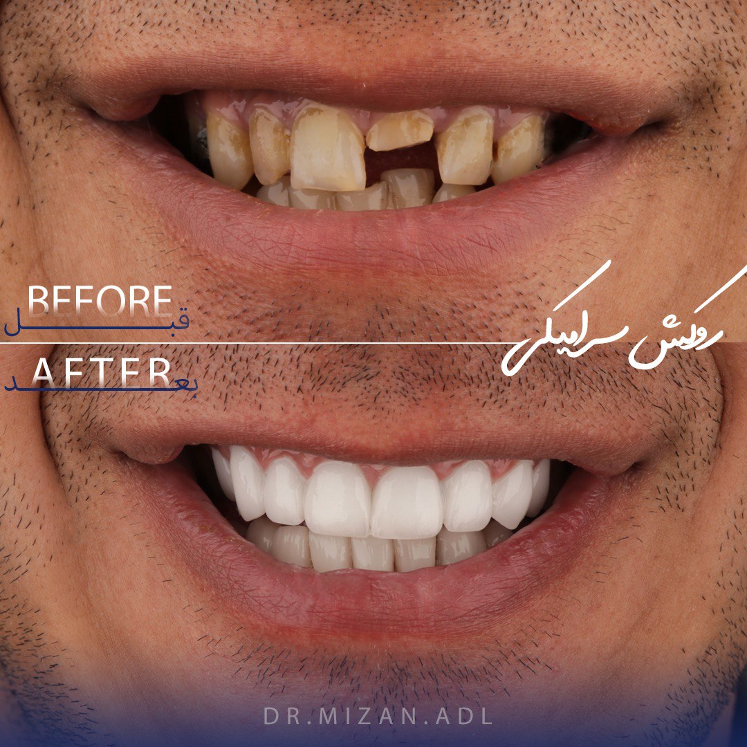 alt روکش سرامیکی