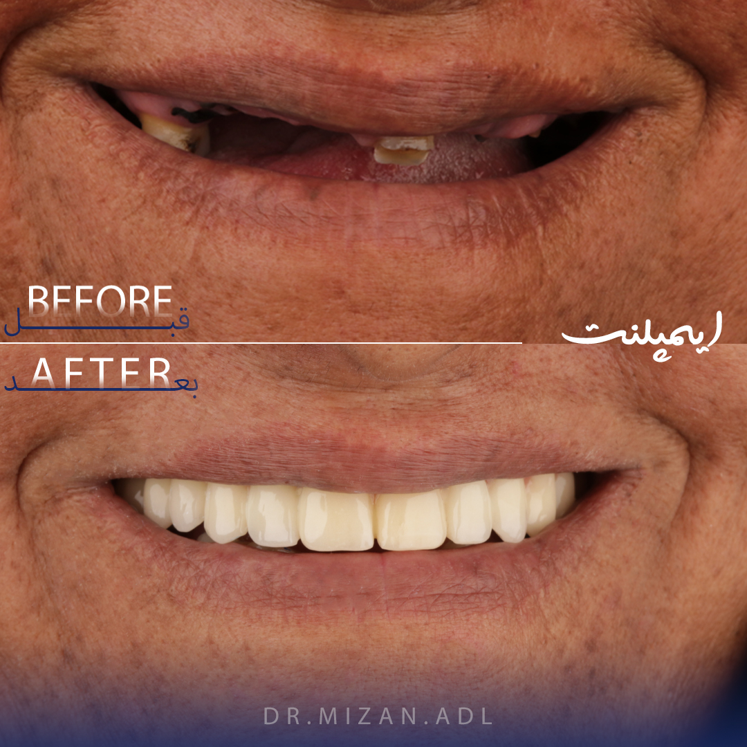 alt ایمپلنت