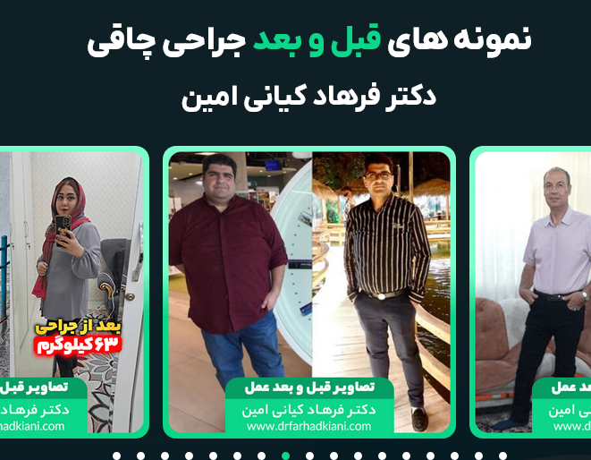 alt قبل و بعد عمل