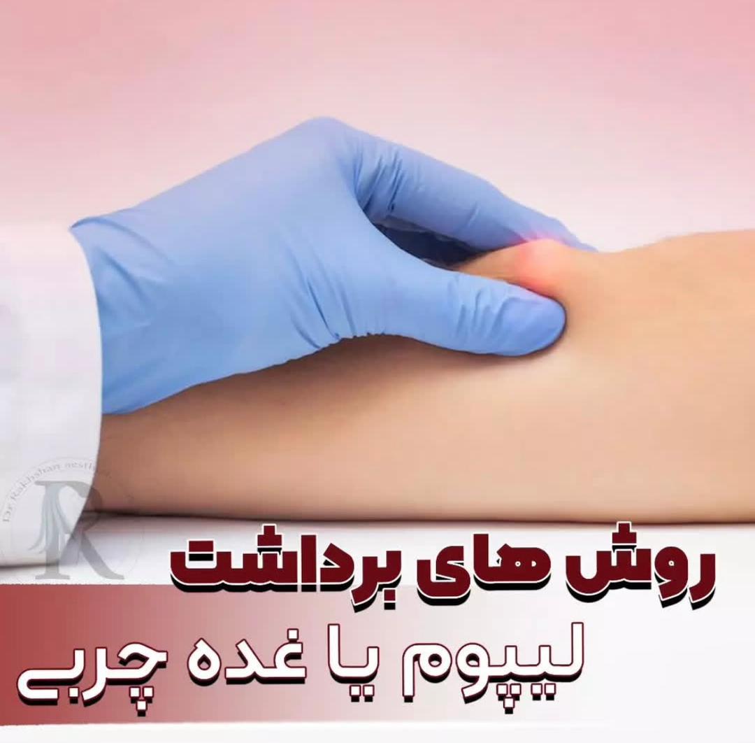 alt برداشت غدد چربی