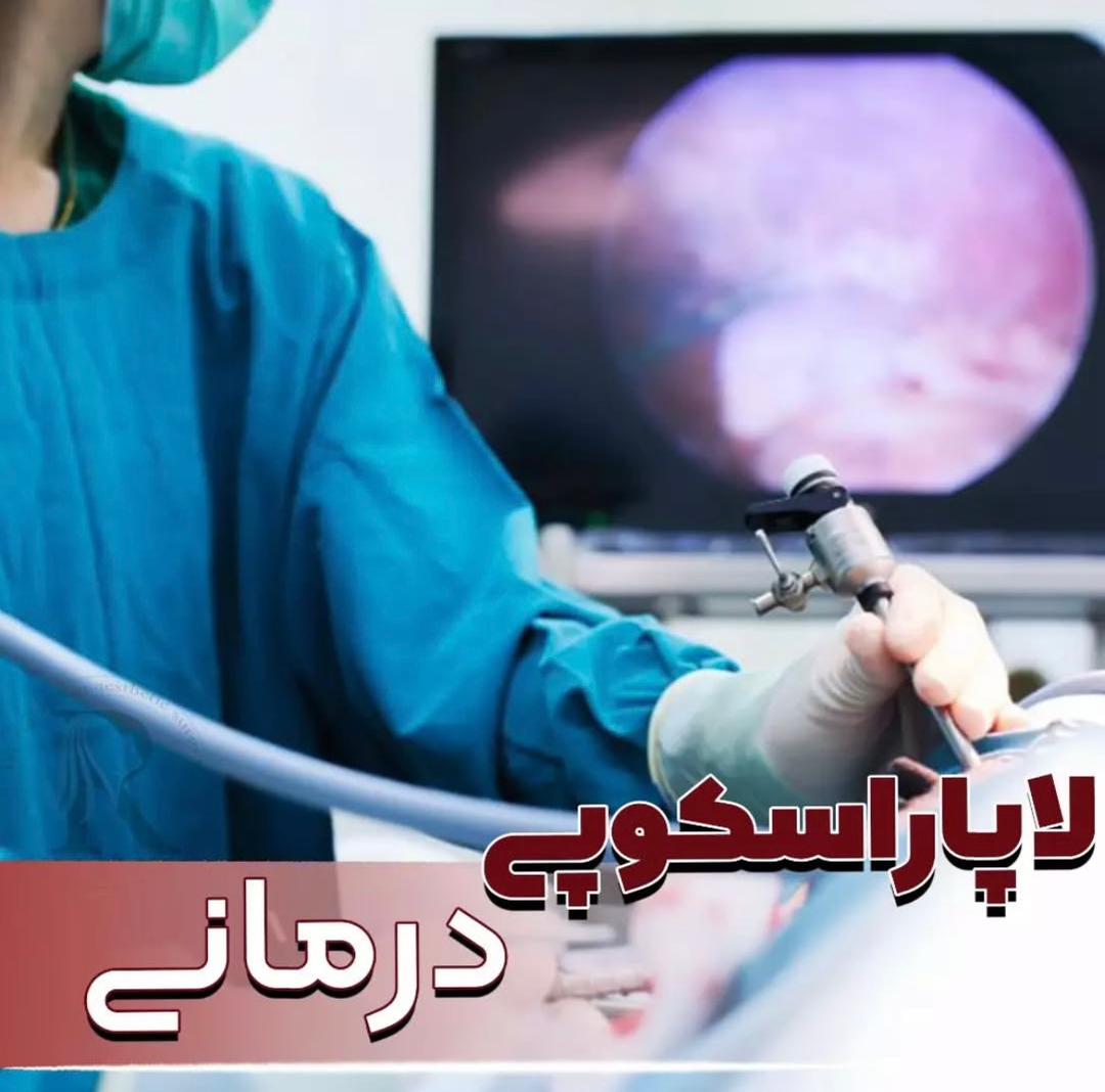 alt لاپاراسکوپی درمانی