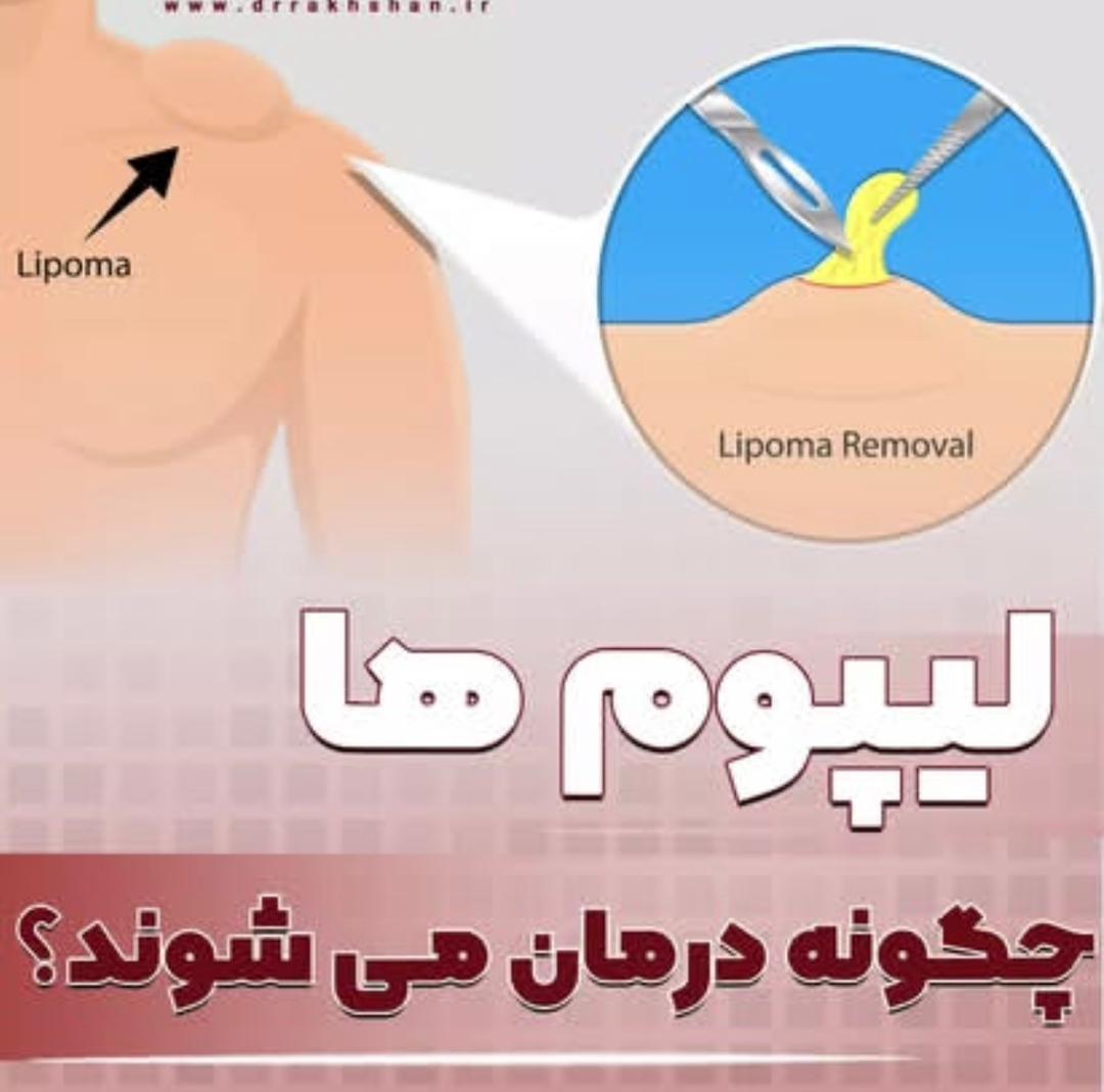 alt لیپوم ها