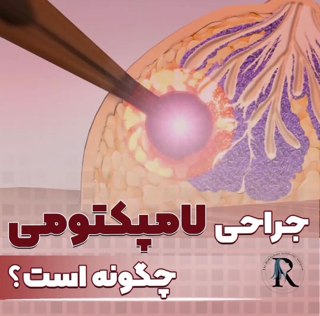 alt جراحی لامپکتومی