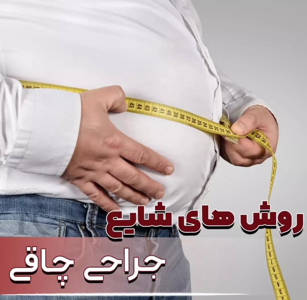 alt روش های جراحی چاقی