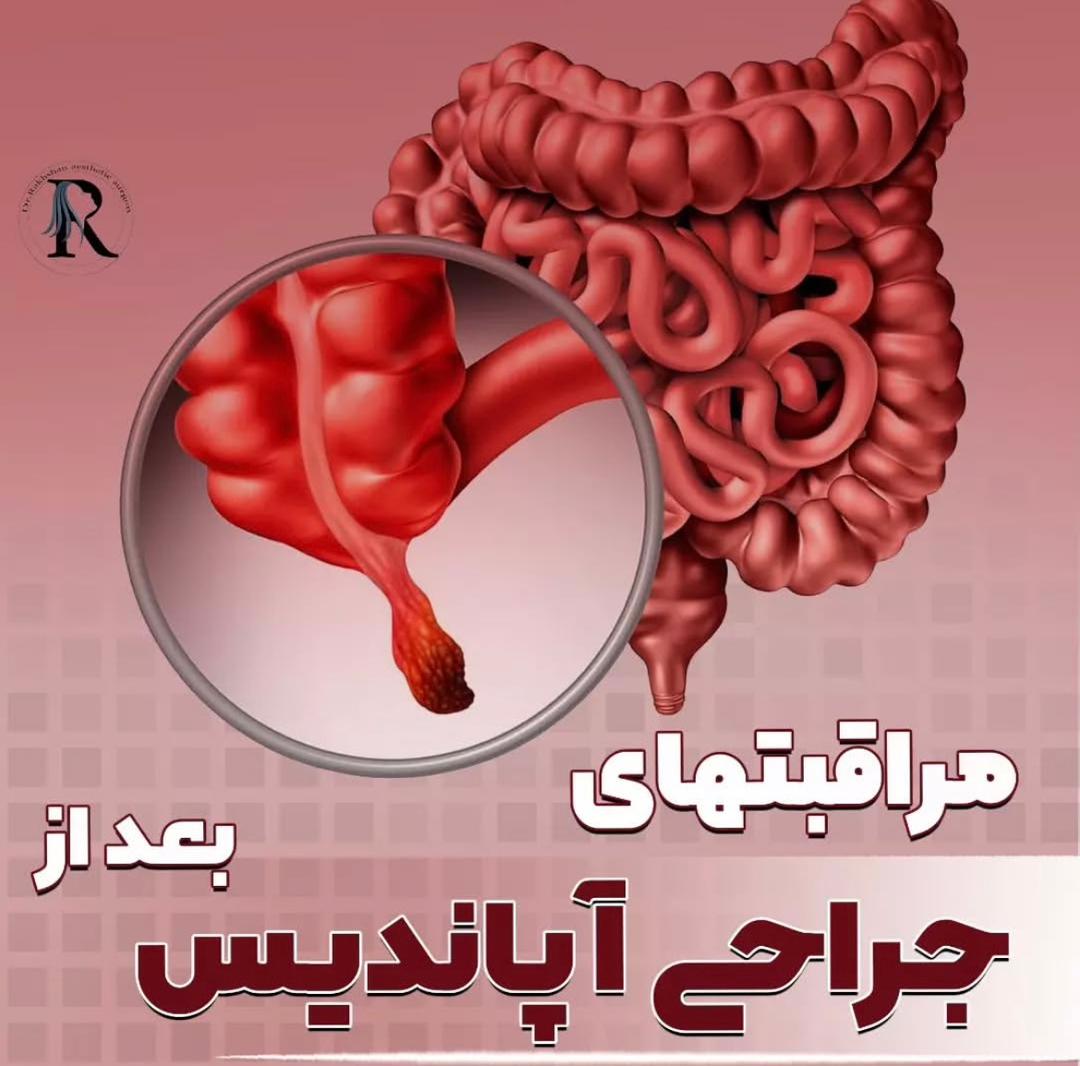 alt مراقبت های جراحی آپاندیس