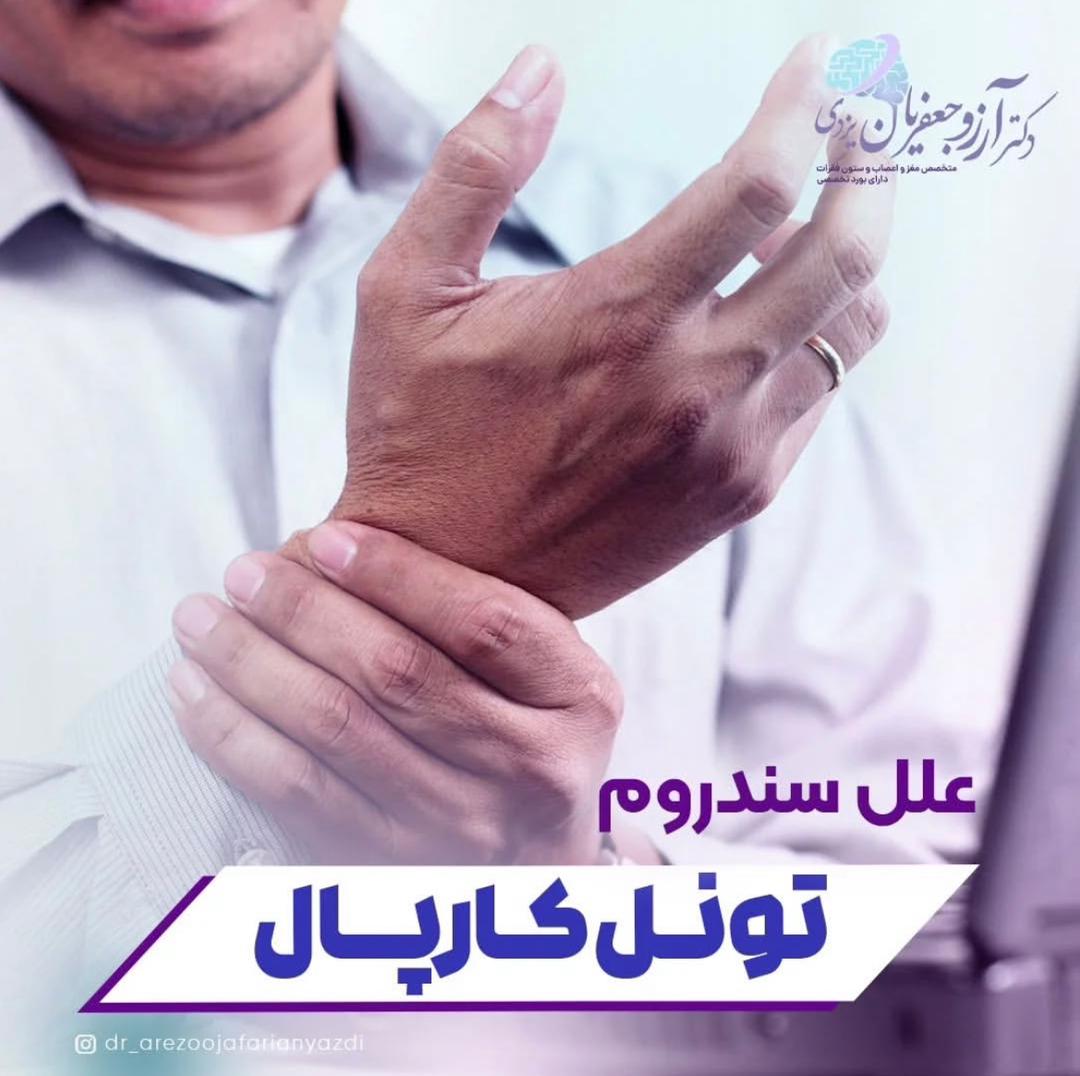 alt سندروم تونل کارپال