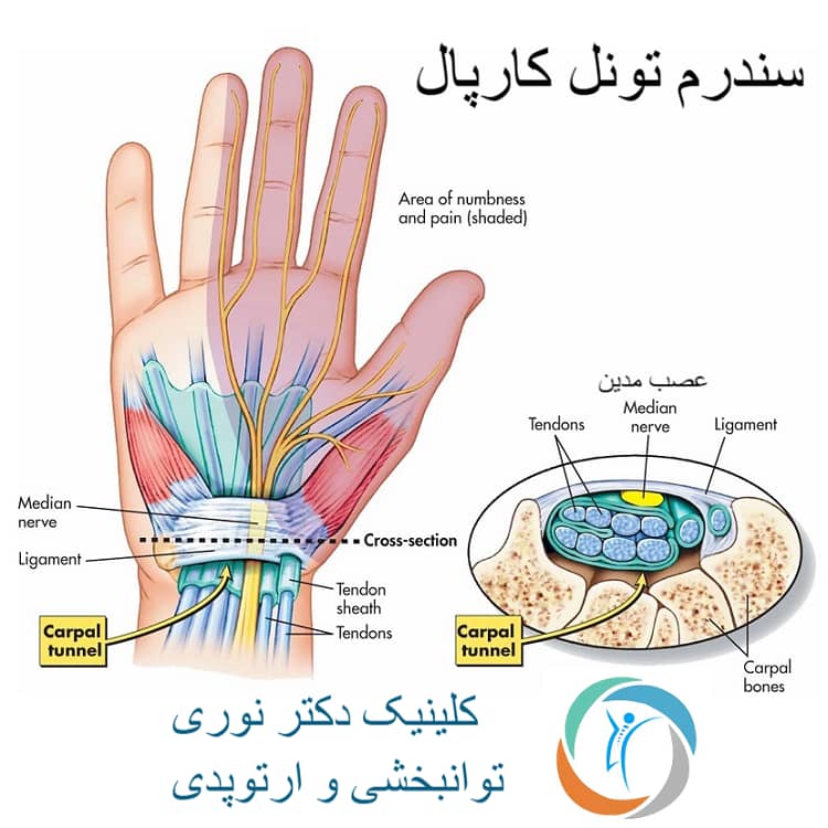 alt سندروم تونل کارپال