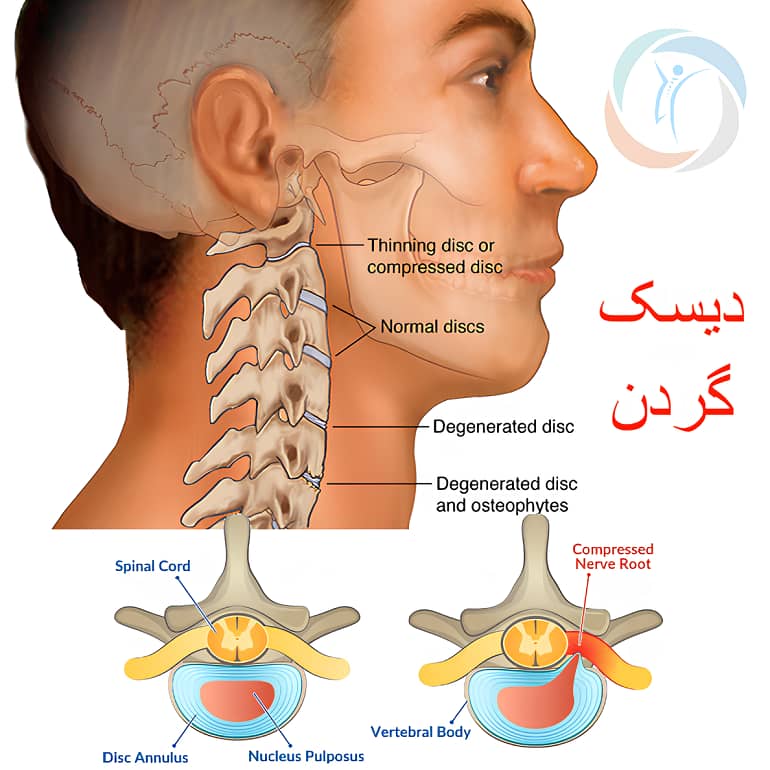 alt دیسک گردن